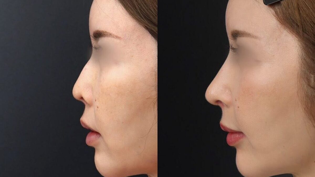 拘縮で短く上を向いた鼻を再建｜重度アップノーズを肋軟骨で整えた他院