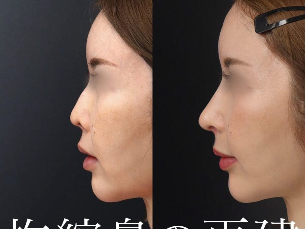 【裁断済み】外鼻形成術 機能と形態を両立した手術 拘縮で短く上を向いた鼻を再建｜重度アップノーズを肋軟骨で整えた他院