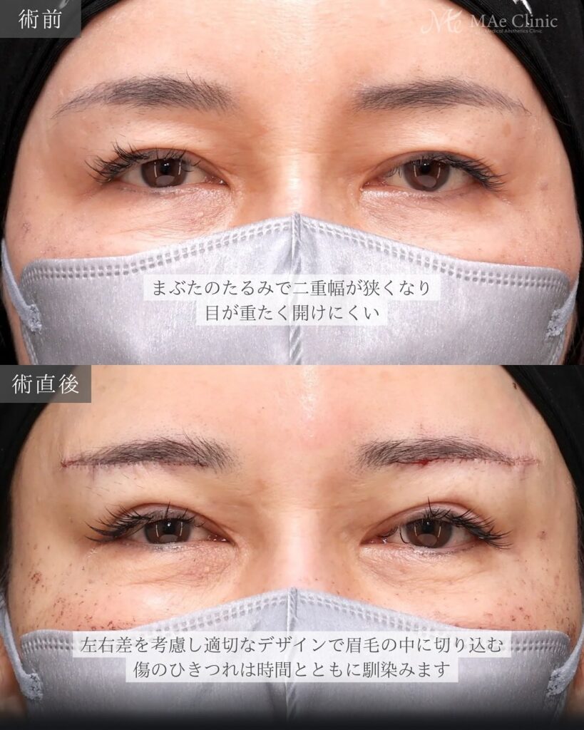 眉下リフト 症例