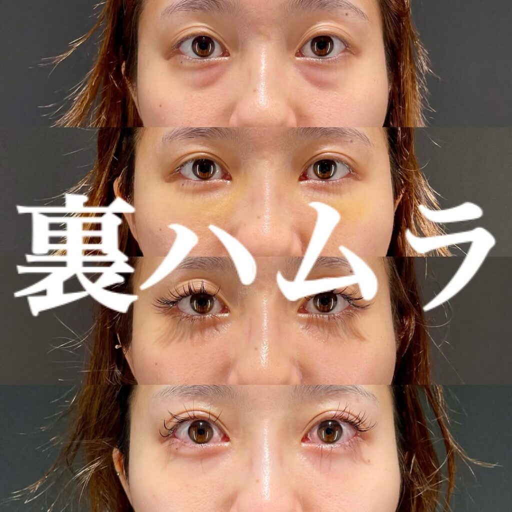裏ハムラ症例