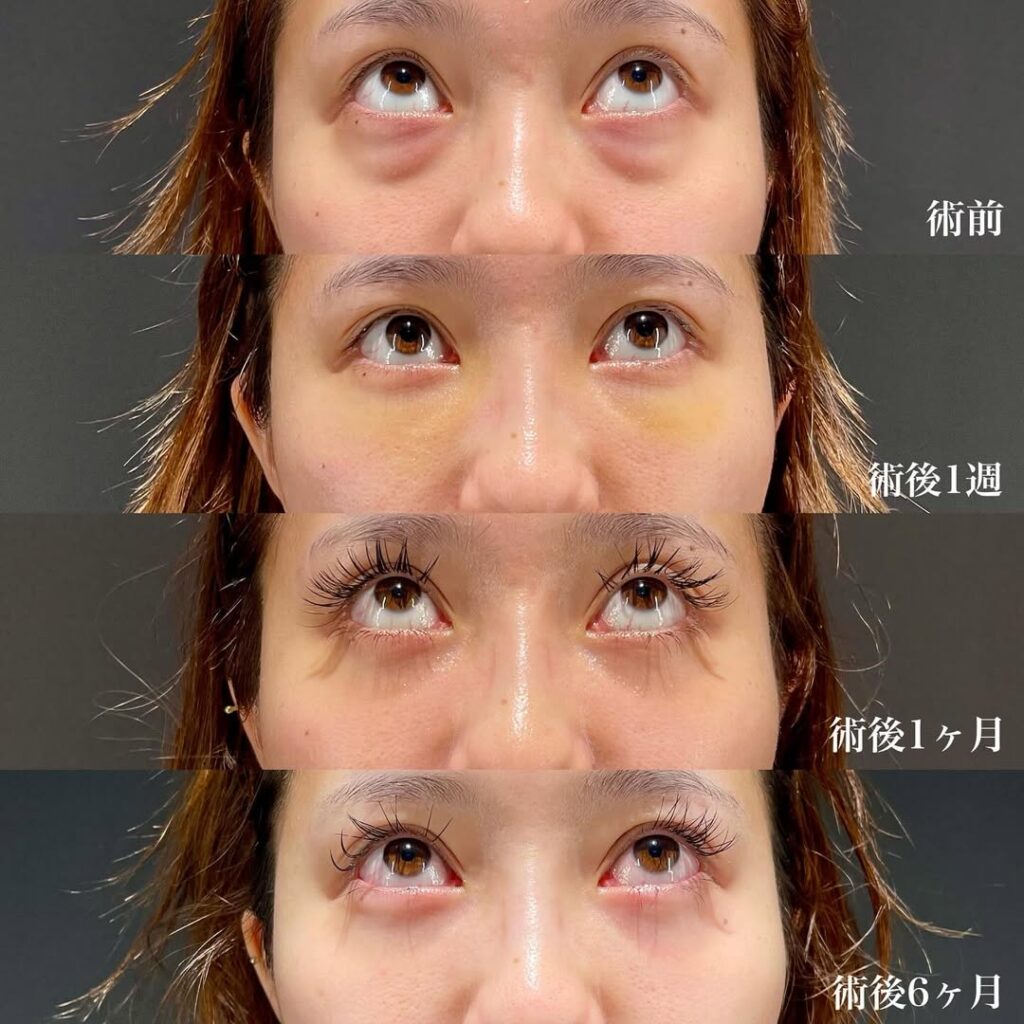 裏ハムラ症例