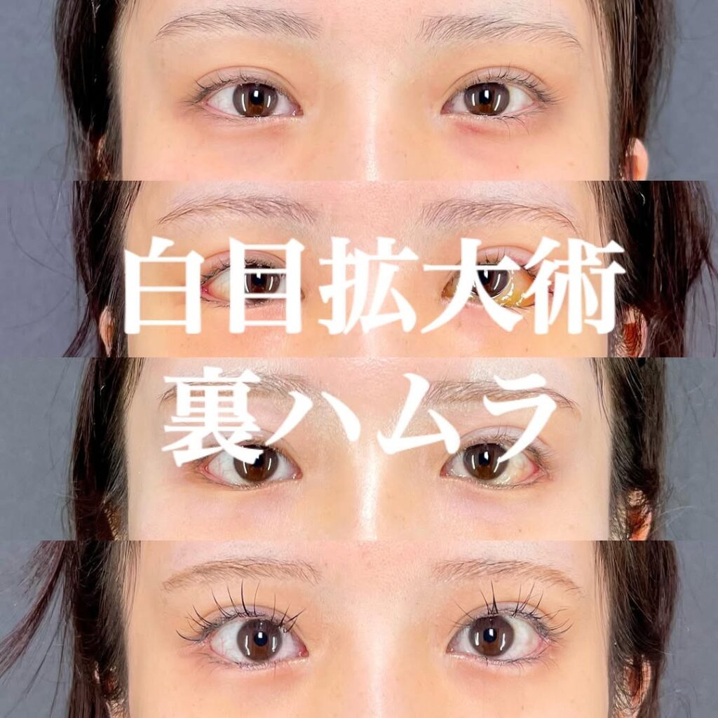 白目拡大術　裏ハムラ　症例