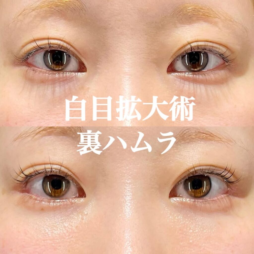 白目拡大術 裏ハムラ 症例