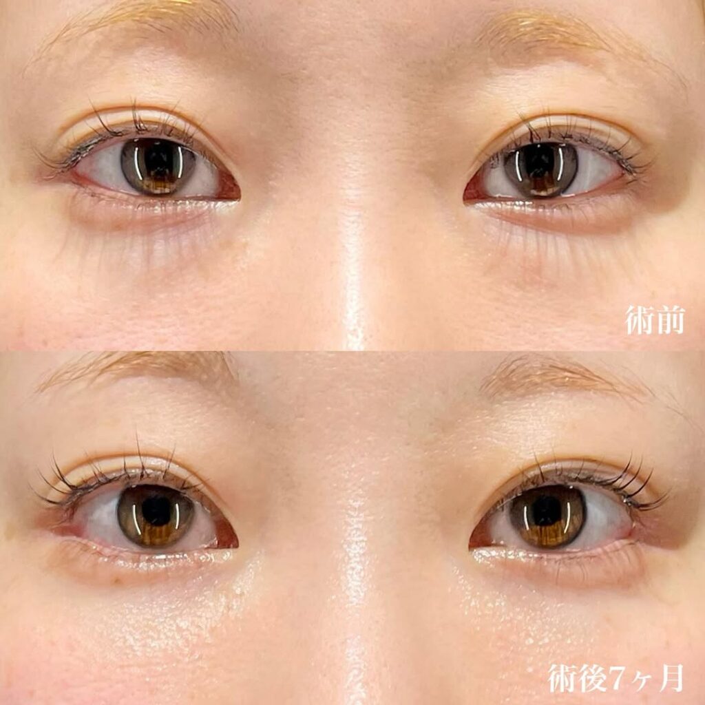 白目拡大術 裏ハムラ 症例