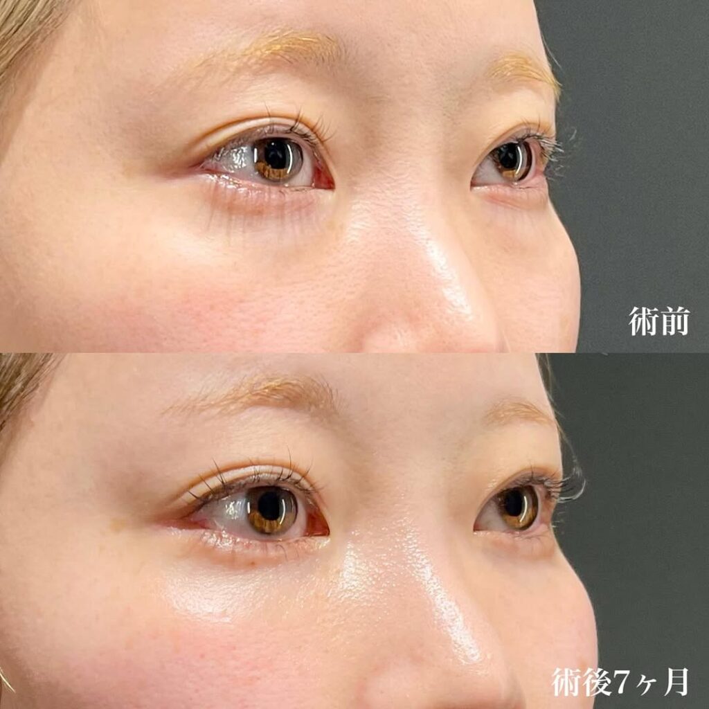 白目拡大術 裏ハムラ 症例