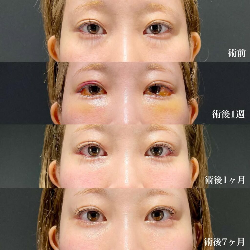 白目拡大術 裏ハムラ 症例
