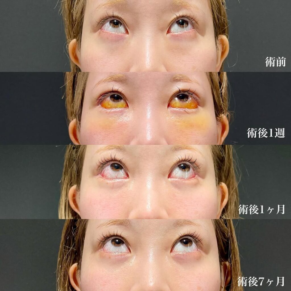 白目拡大術 裏ハムラ 症例
