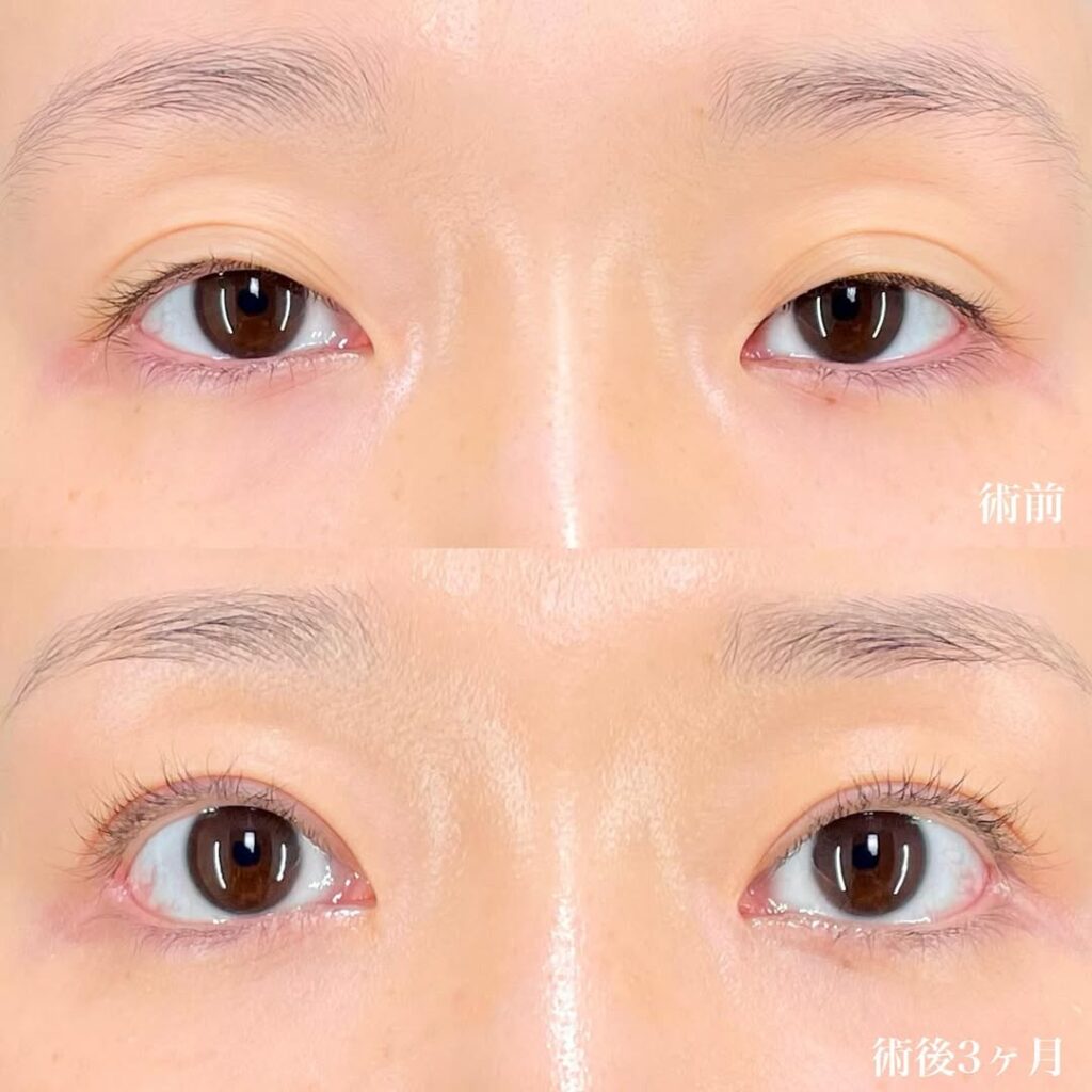 切開眼瞼下垂 目頭切開リドレープ法 白目拡大(目尻切開+目尻靱帯移動+結膜切開グラマラスライン) 裏ハムラ 術後3ヵ月症例