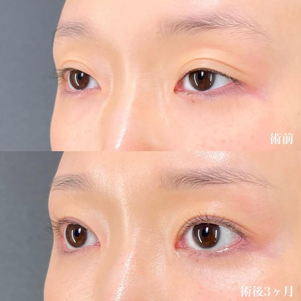 切開眼瞼下垂 目頭切開リドレープ法 白目拡大(目尻切開+目尻靱帯移動+結膜切開グラマラスライン) 裏ハムラ 術後3ヵ月症例