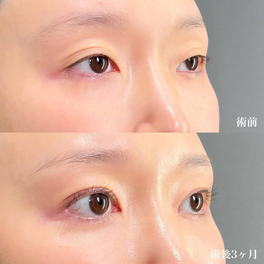 切開眼瞼下垂 目頭切開リドレープ法 白目拡大(目尻切開+目尻靱帯移動+結膜切開グラマラスライン) 裏ハムラ 術後3ヵ月症例