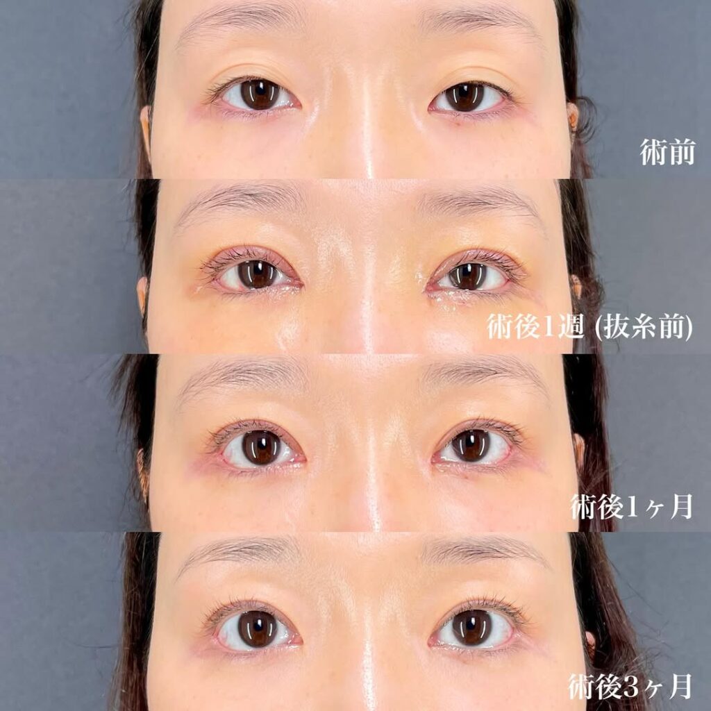 切開眼瞼下垂 目頭切開リドレープ法 白目拡大(目尻切開+目尻靱帯移動+結膜切開グラマラスライン) 裏ハムラ 術後3ヵ月症例