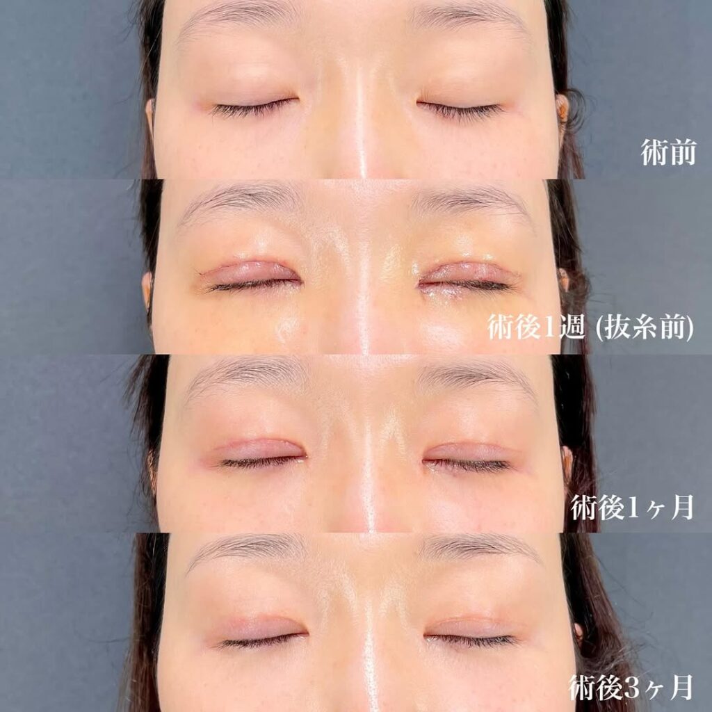 切開眼瞼下垂 目頭切開リドレープ法 白目拡大(目尻切開+目尻靱帯移動+結膜切開グラマラスライン) 裏ハムラ 術後3ヵ月症例