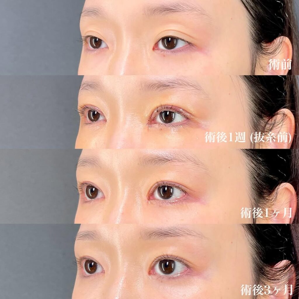 切開眼瞼下垂 目頭切開リドレープ法 白目拡大(目尻切開+目尻靱帯移動+結膜切開グラマラスライン) 裏ハムラ 術後3ヵ月症例