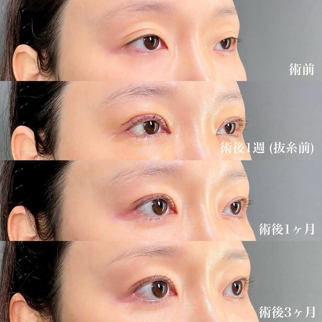 切開眼瞼下垂 目頭切開リドレープ法 白目拡大(目尻切開+目尻靱帯移動+結膜切開グラマラスライン) 裏ハムラ 術後3ヵ月症例