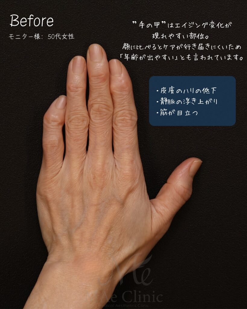 手の甲　脂肪注入　症例