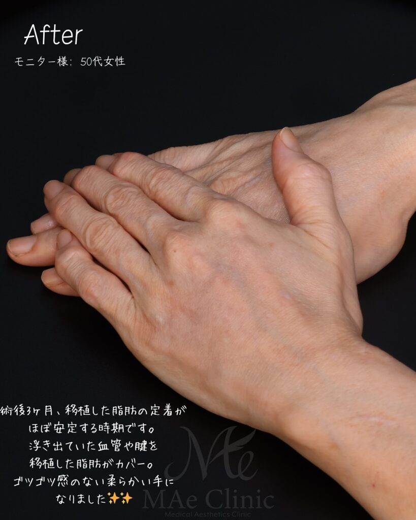 手の甲　脂肪注入　症例
