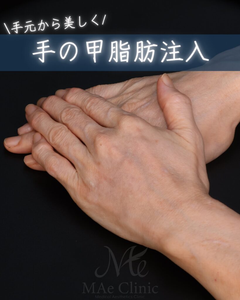 手の甲　脂肪注入　症例
