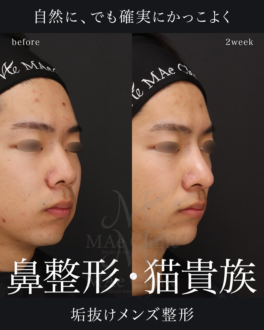・鼻中隔延長（肋軟骨） ・鼻尖形成 ・鼻尖軟骨移植 ・猫貴族手術（肋軟骨） ・顎先軟骨移植（肋軟骨） ・自家組織隆鼻 術後経過：2週間 症例