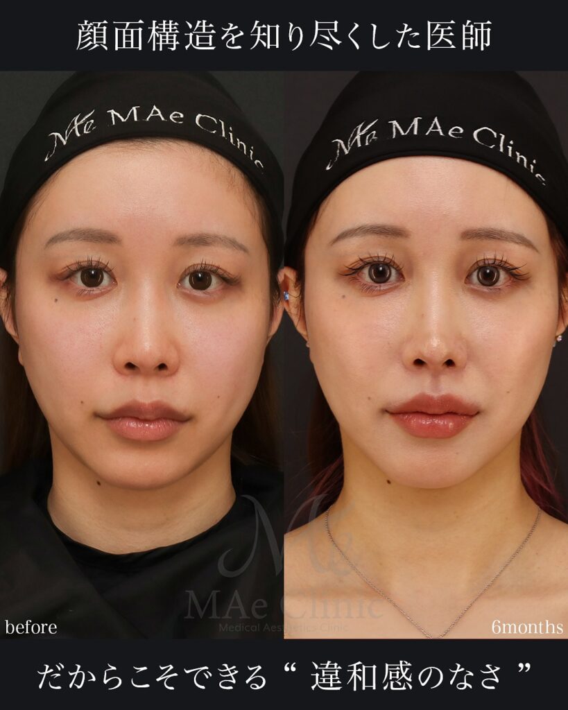 人中短縮 人中厚み調整3D 外側人中短縮 術後6ヵ月 症例