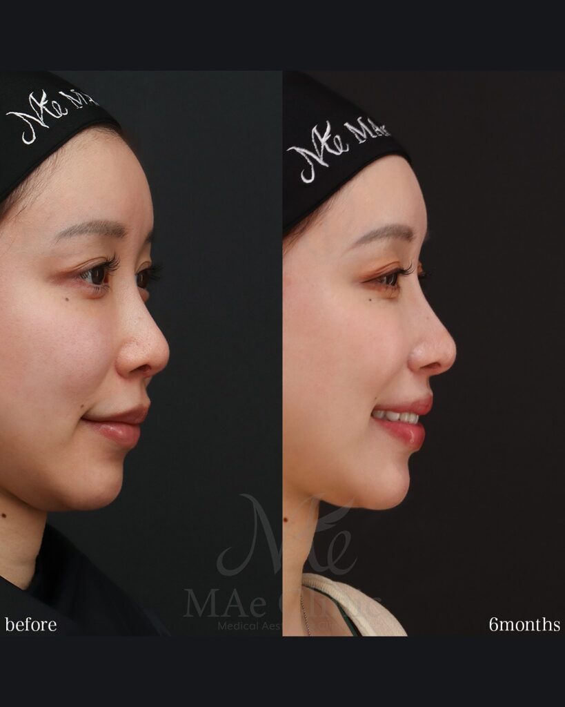 人中短縮 人中厚み調整3D 外側人中短縮 術後6ヵ月 症例