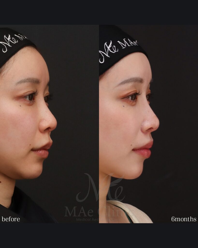 人中短縮 人中厚み調整3D 外側人中短縮 術後6ヵ月 症例
