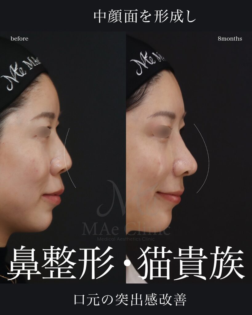 鼻中隔延長(肋軟骨)鼻尖形成
鼻尖軟骨移植
ハンプ切除
鼻翼縮小(内+外)
猫貴族手術
【経過】8ヶ月 症例