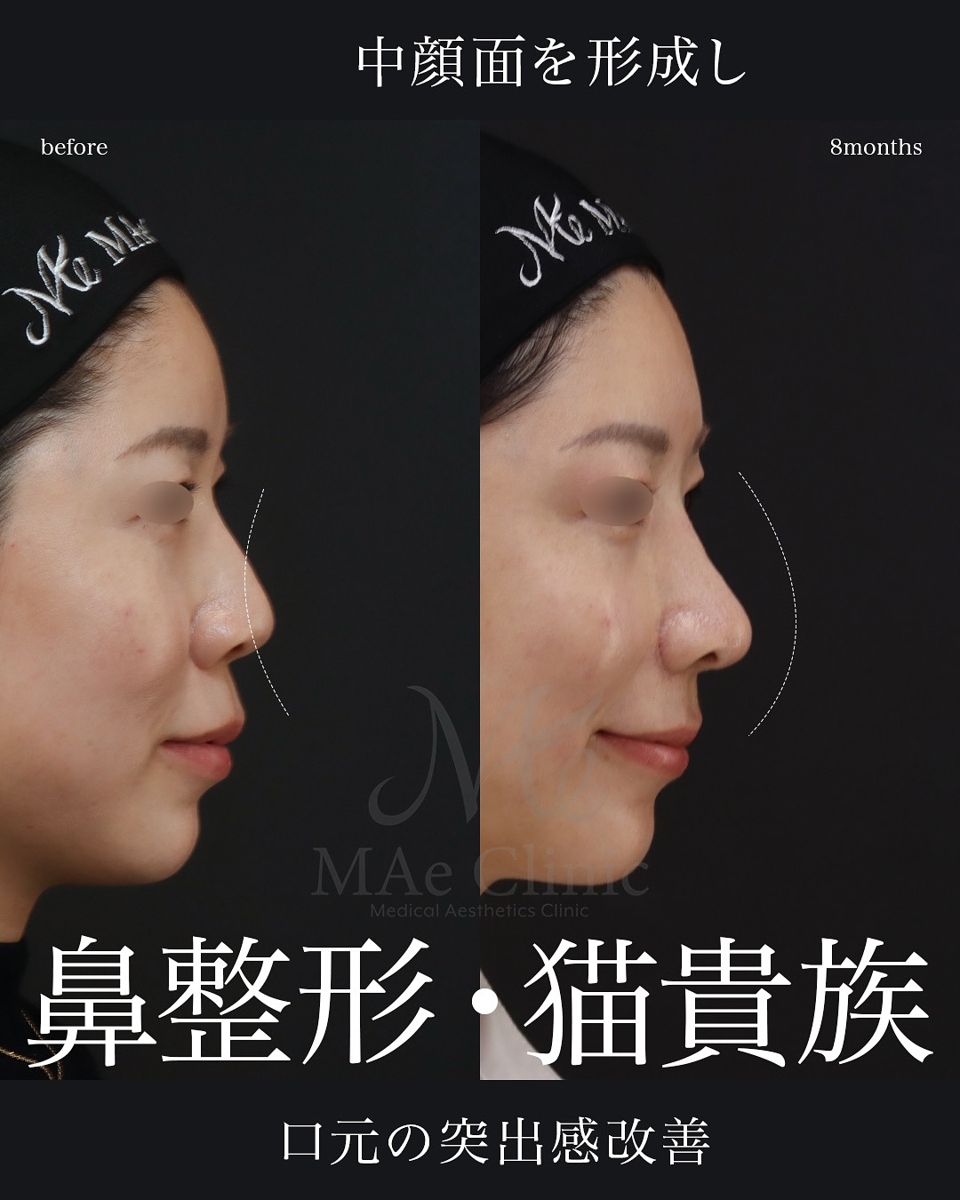 裁断済　外鼻形成術 : 機能と形態を両立した手術 71FfTHk9QrL._AC_UF1000,