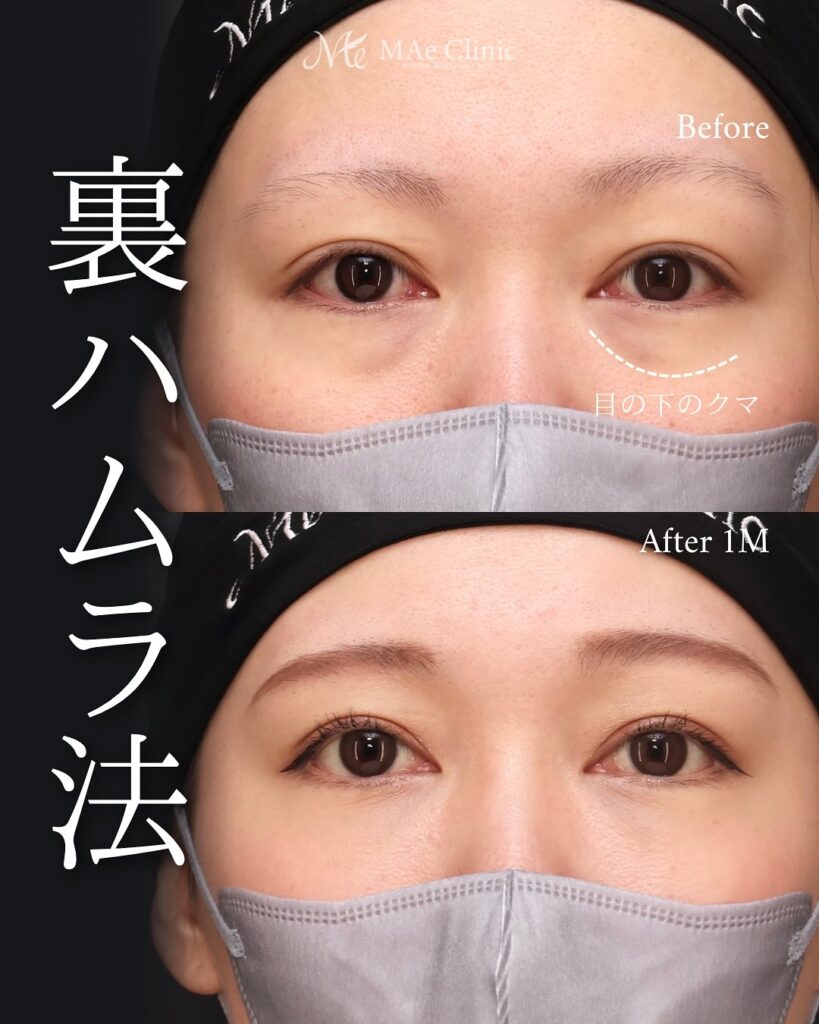 裏ハムラ法　症例