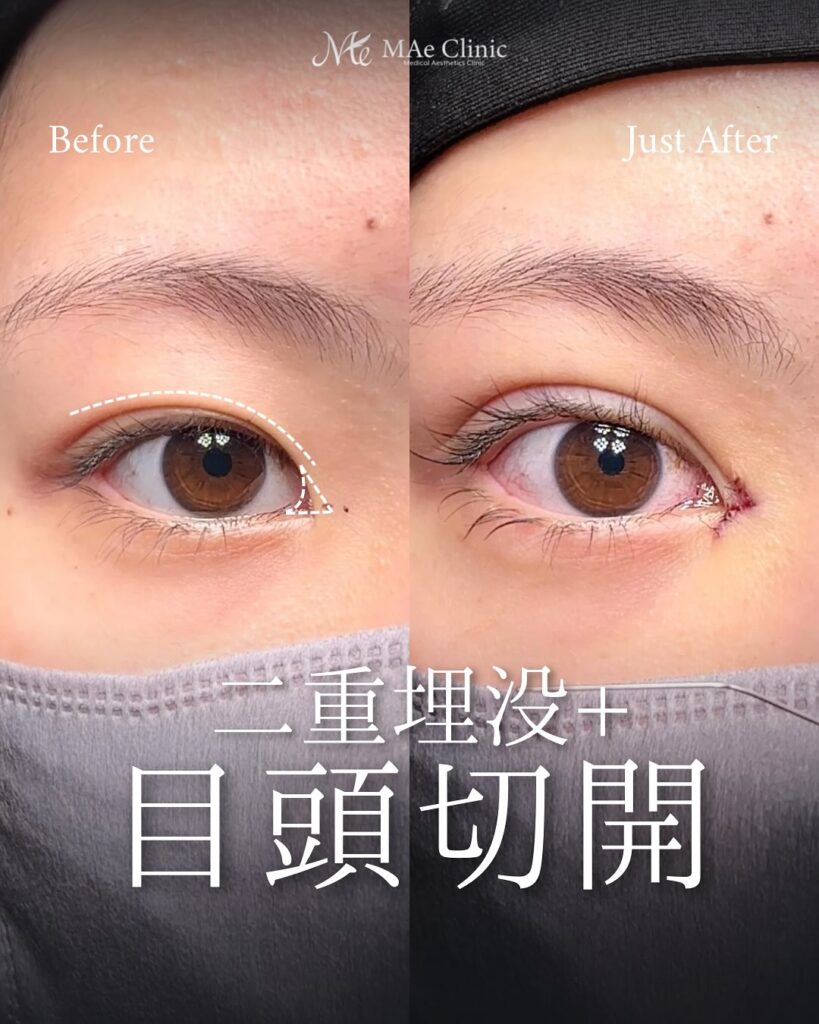 目頭切開 症例