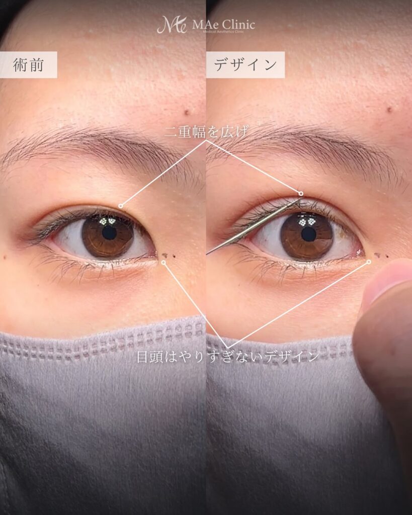 目頭切開 症例