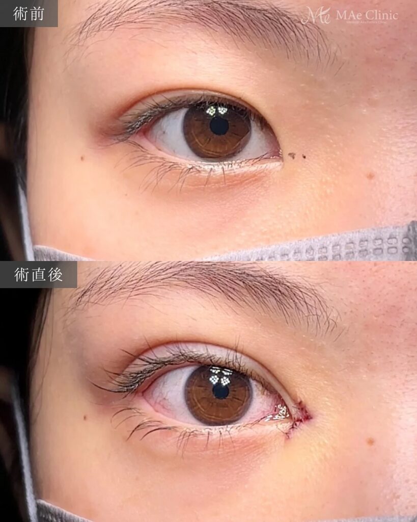 目頭切開 症例