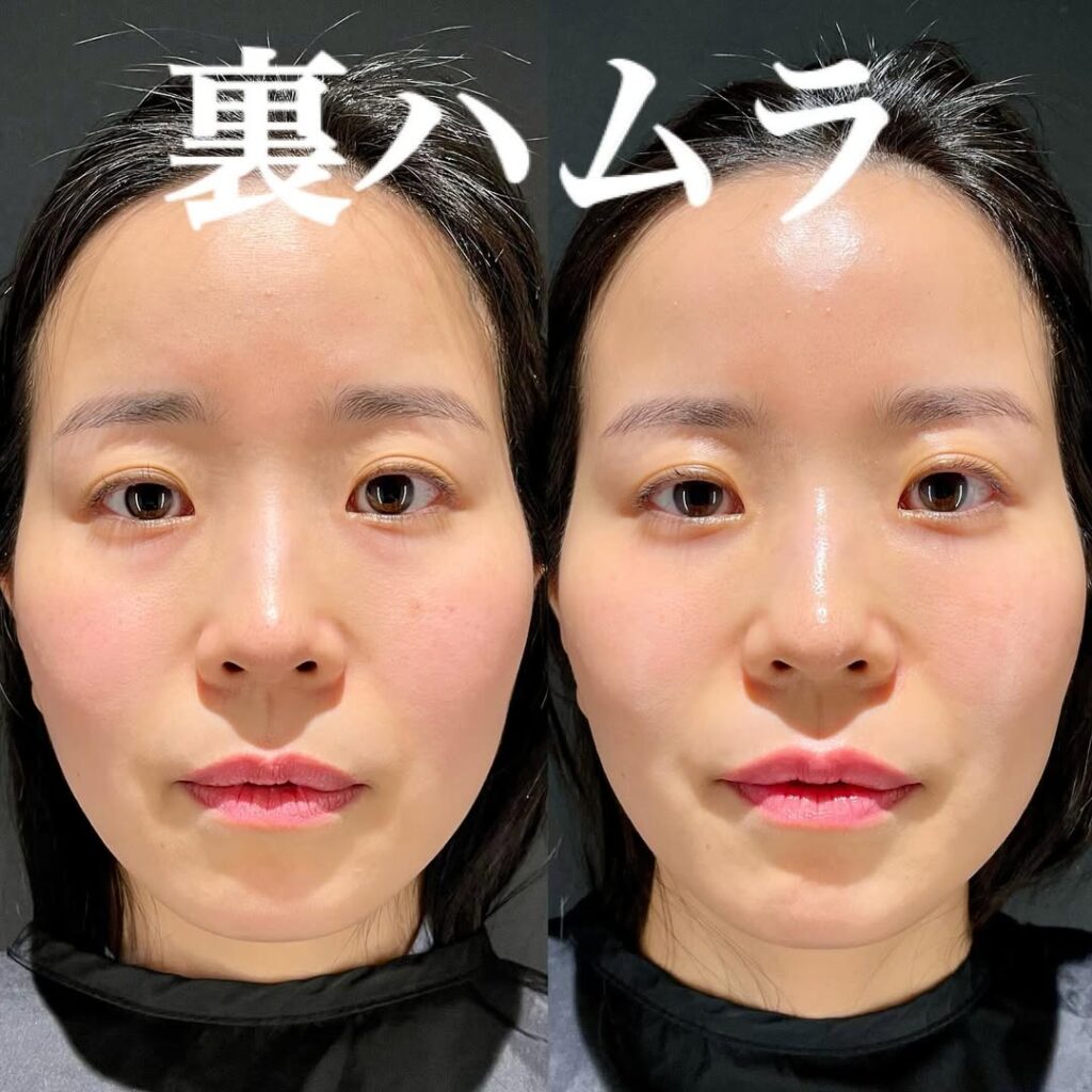 裏ハムラ症例