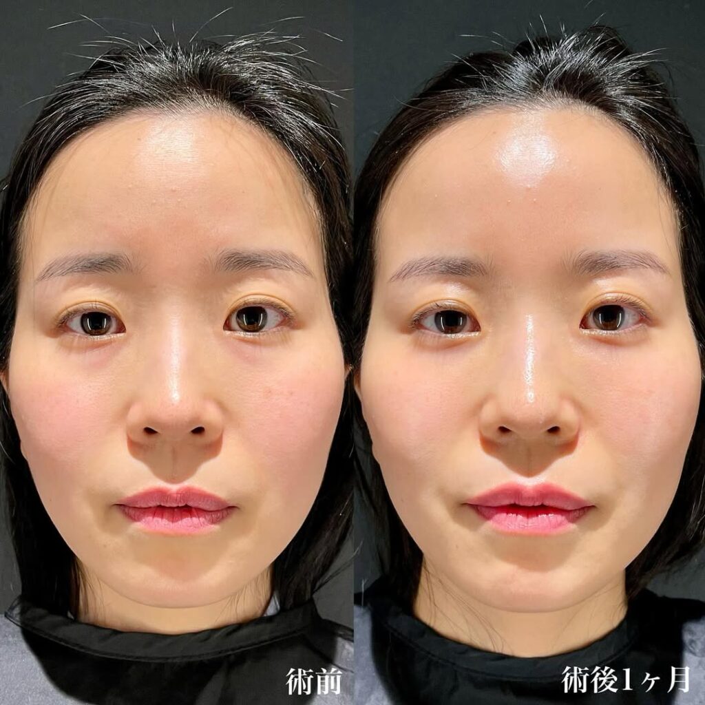 裏ハムラ症例