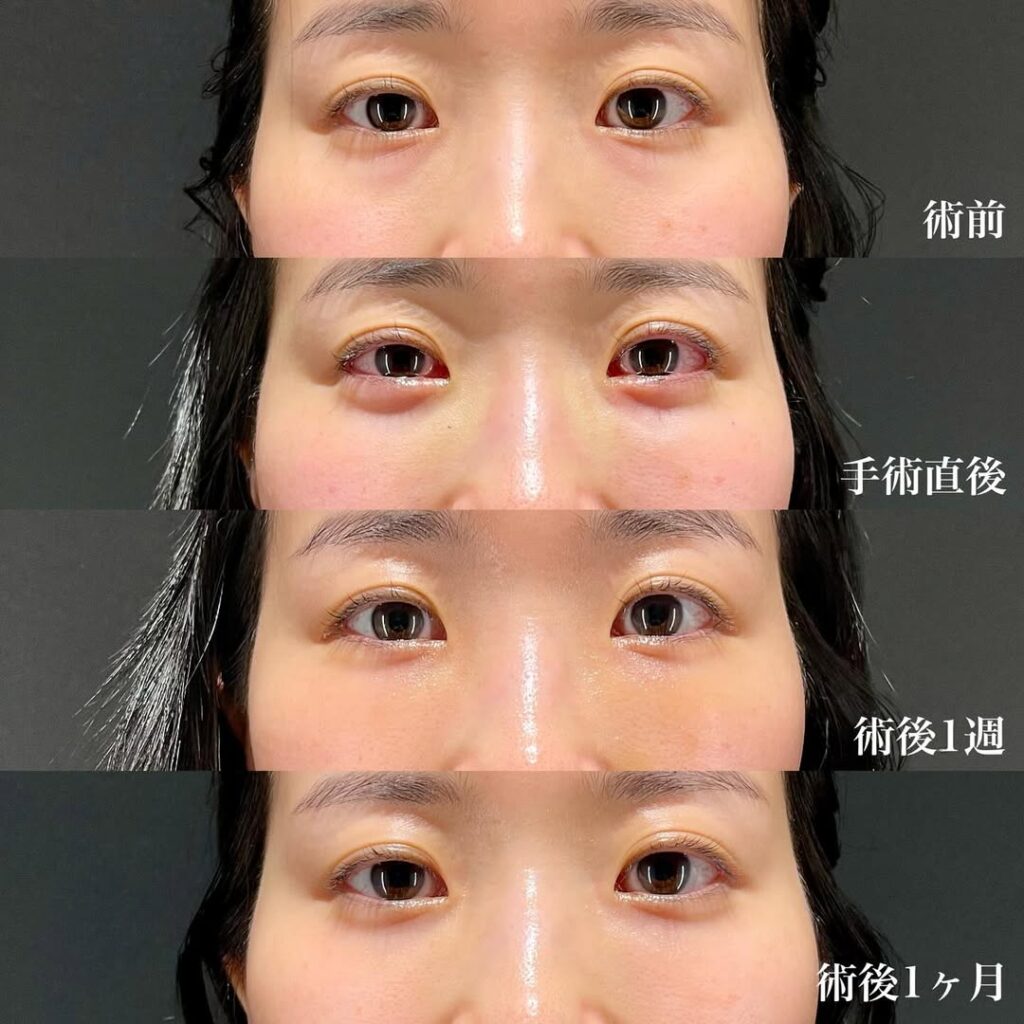 裏ハムラ症例