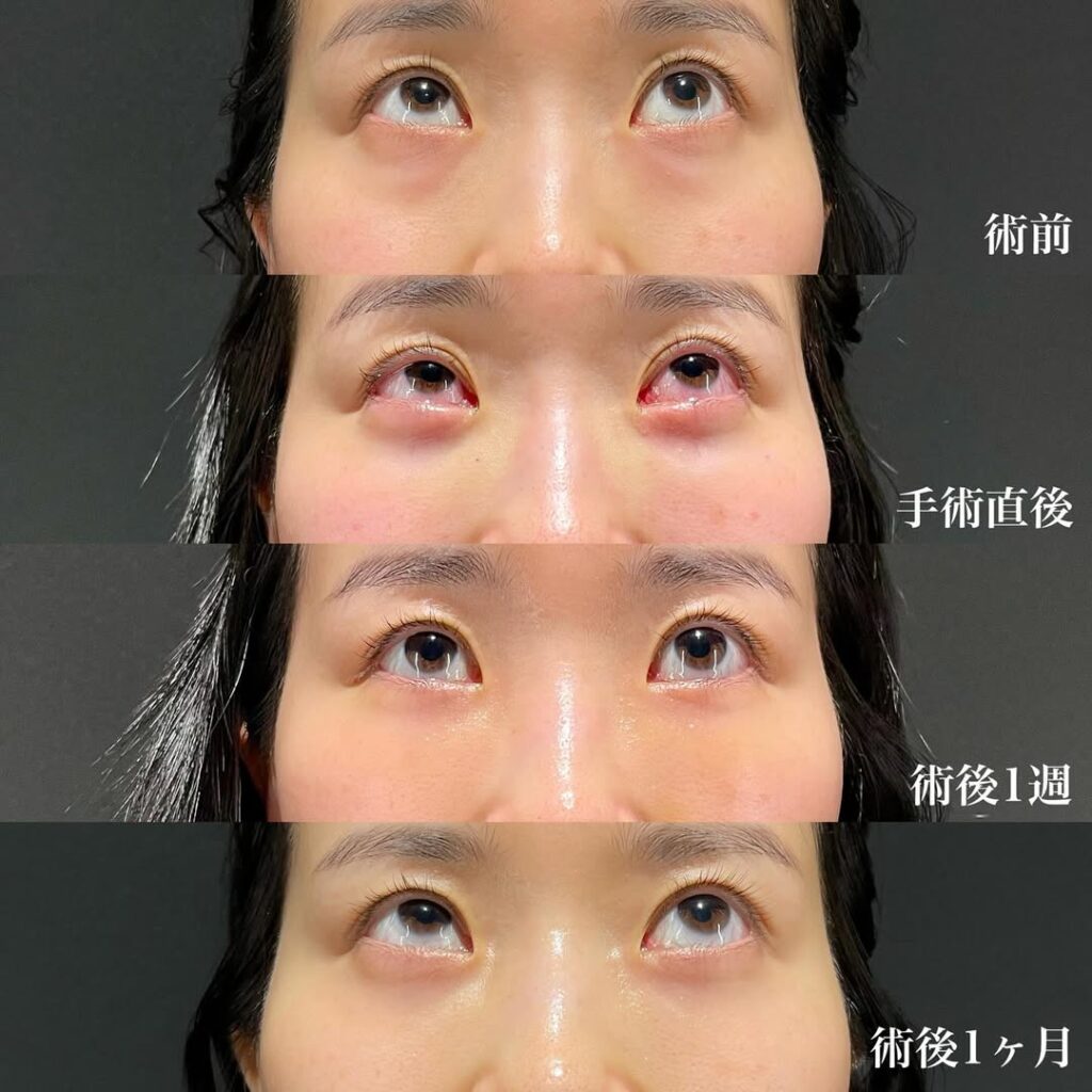 裏ハムラ症例