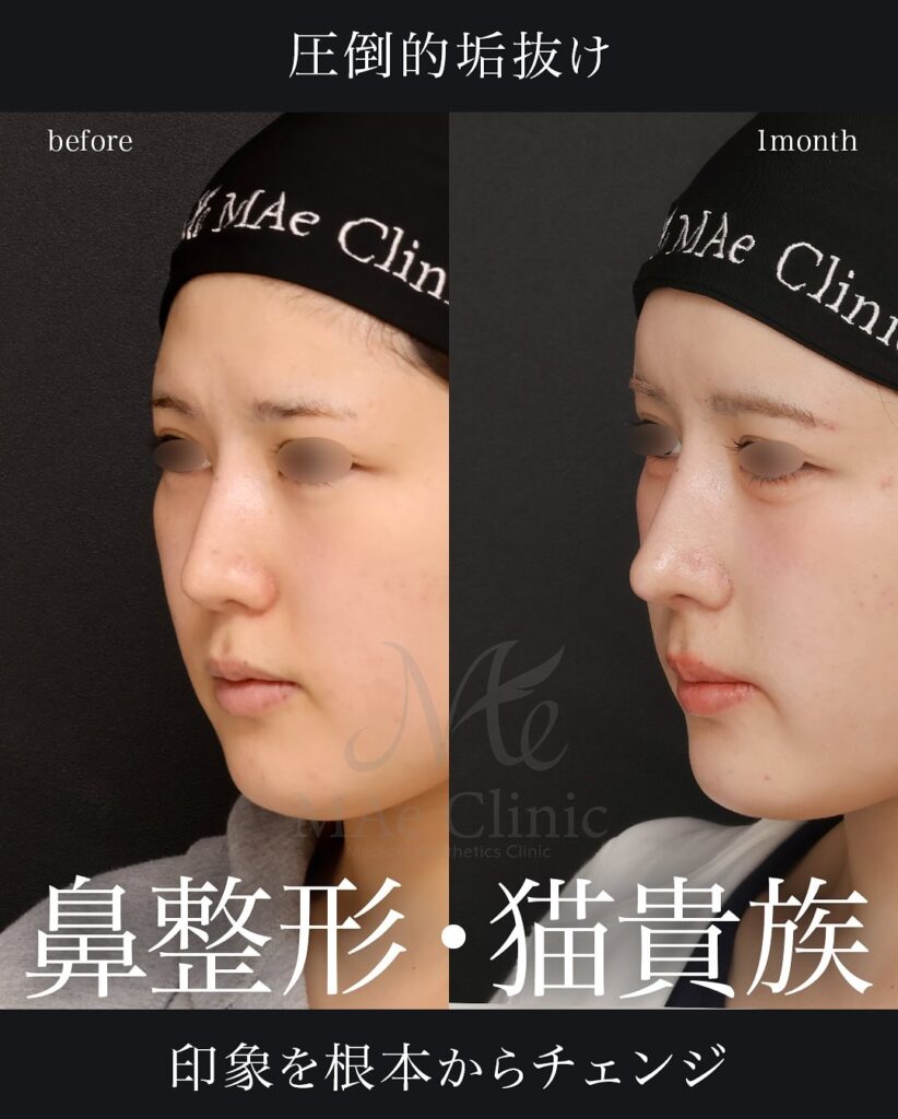 鼻中隔延長(肋軟骨) 鼻尖形成 鼻尖軟骨移植 猫貴族手術(肋軟骨) 自家組織隆鼻 症例