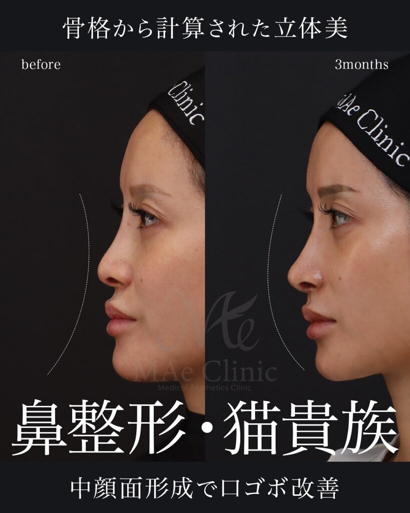 ▶︎鼻中隔延長（肋軟骨）
▶︎鼻尖形成
▶︎鼻尖軟骨移植
▶︎隆鼻（肋軟骨）
▶︎猫貴族手術

【経過】3ヶ月　症例