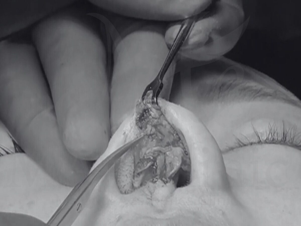 鼻整形の異物がもたらす崩壊｜感染・変形・欠損の実態【術中映像あり