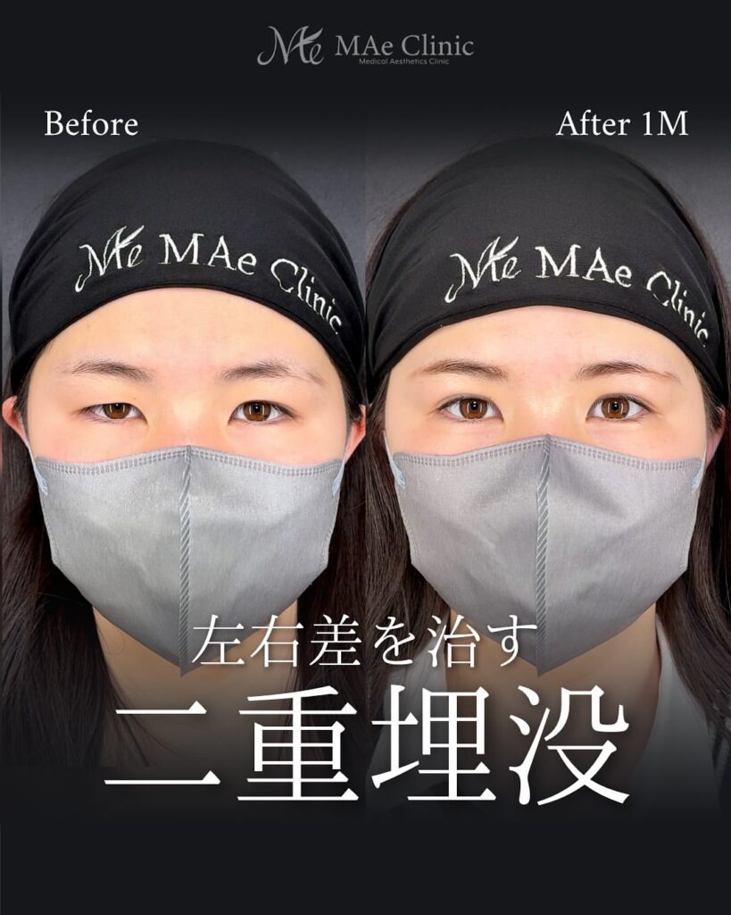 二重埋没　症例