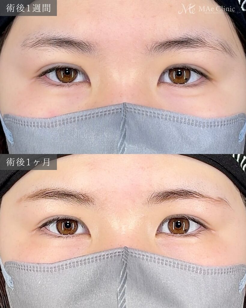 二重埋没　症例