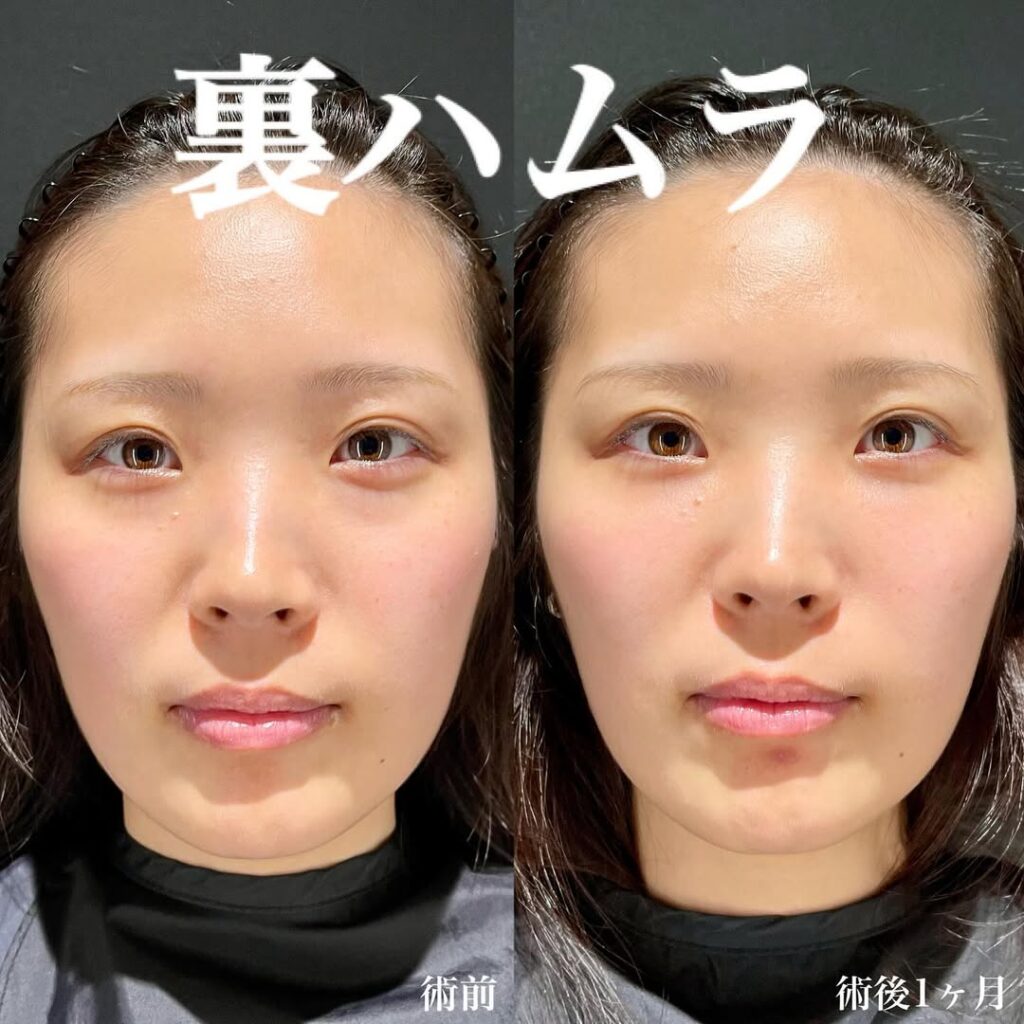 裏ハムラ症例