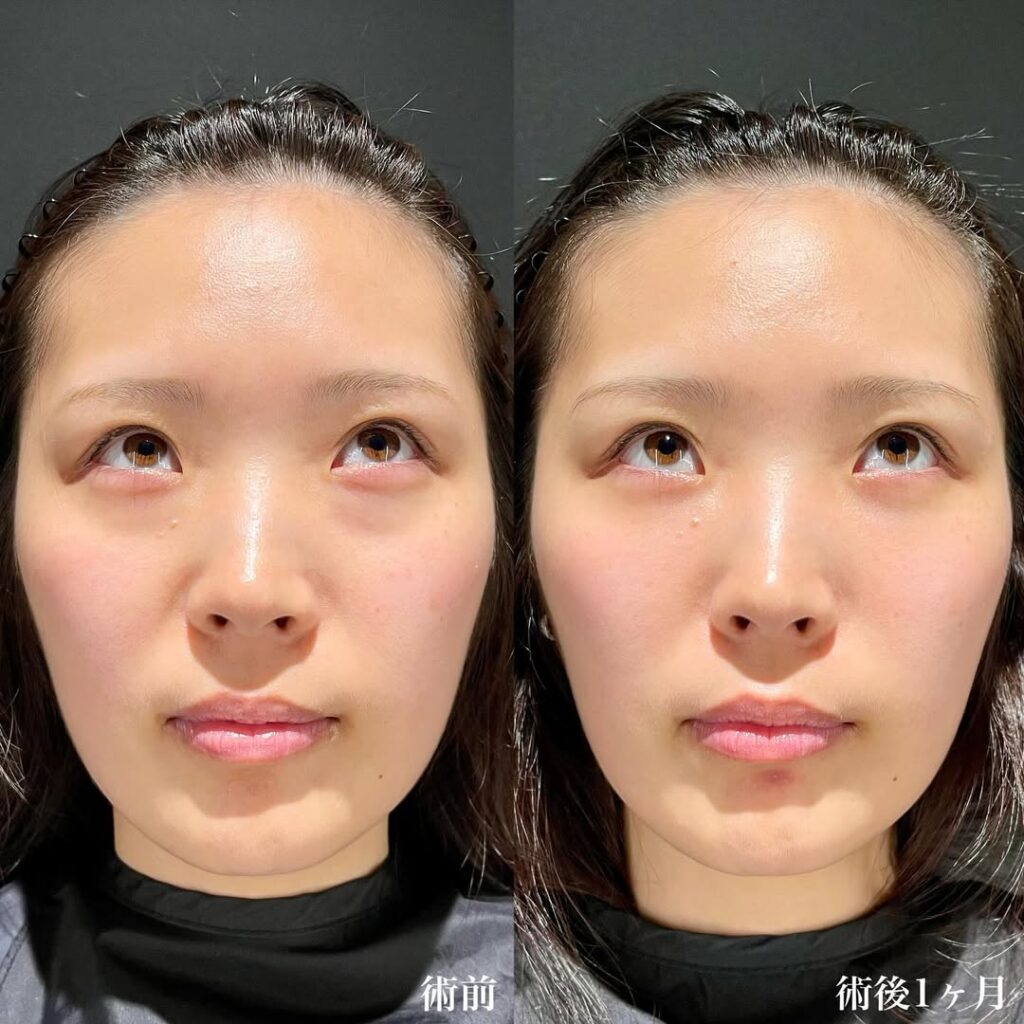 裏ハムラ症例