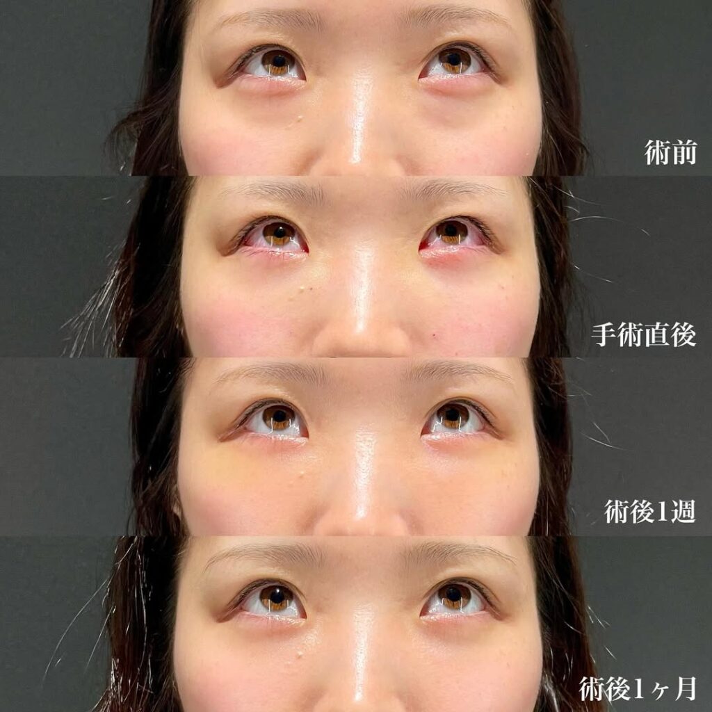 裏ハムラ症例