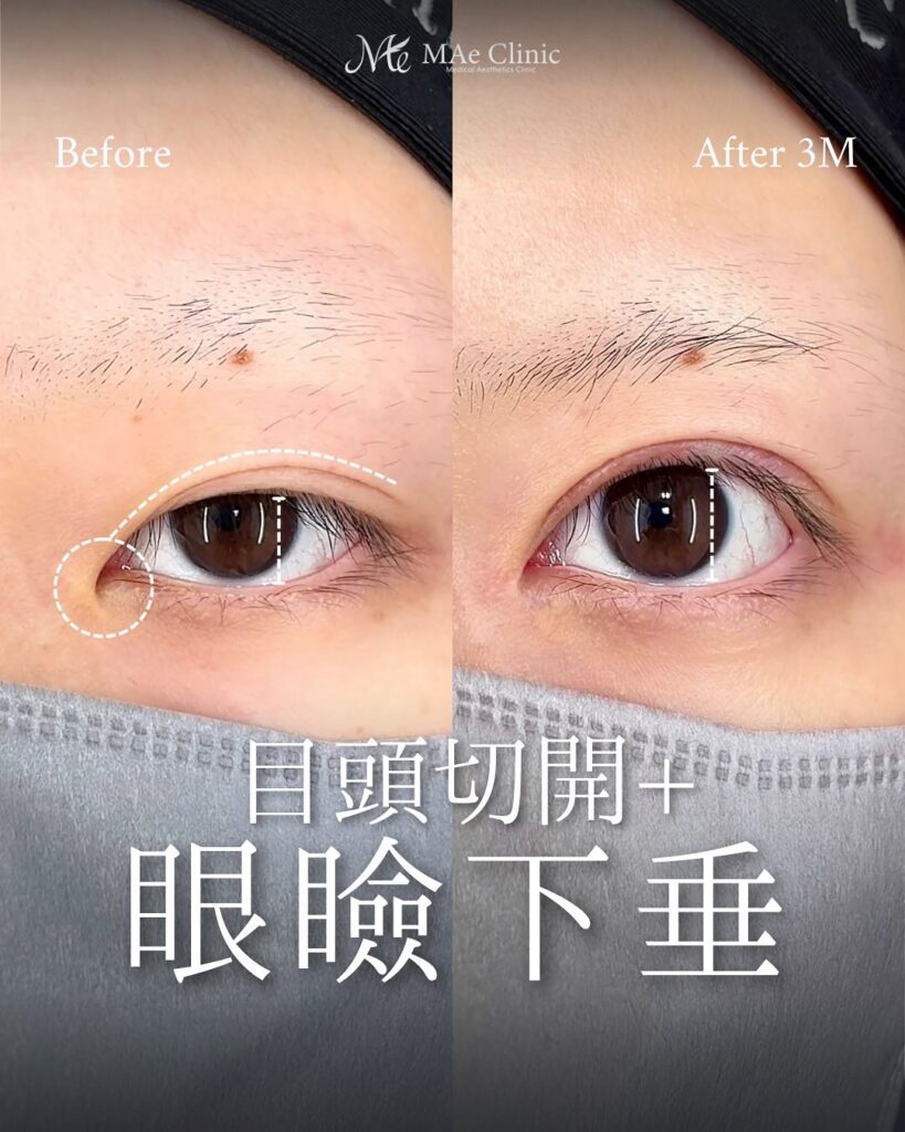 目頭切開 眼瞼下垂 症例