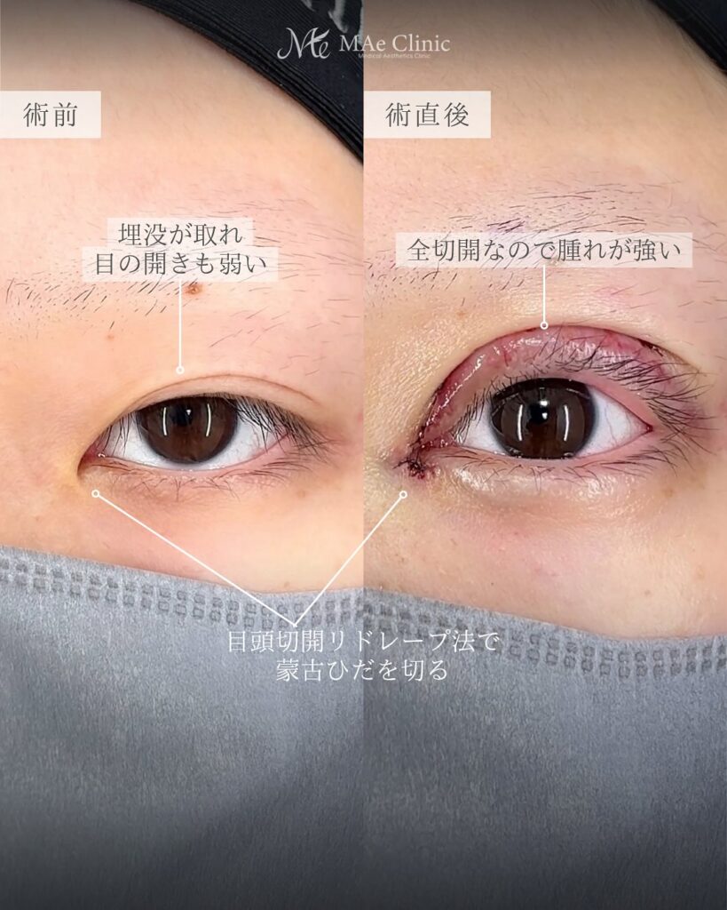 目頭切開 眼瞼下垂 症例