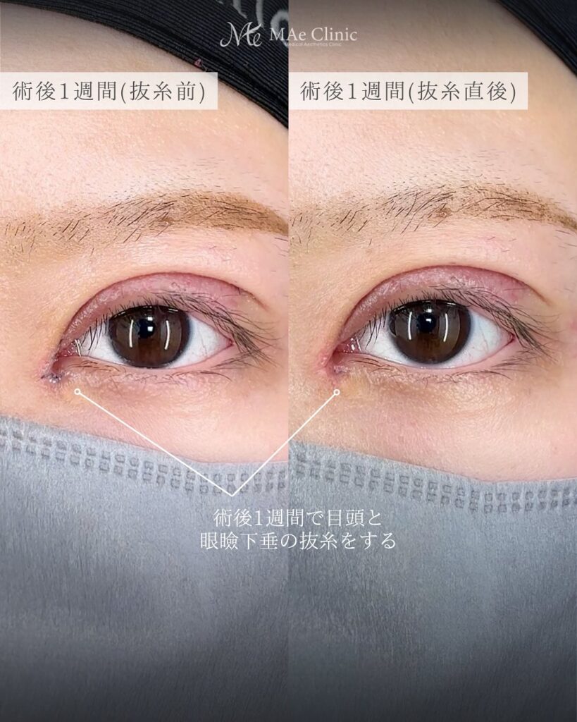 目頭切開 眼瞼下垂 症例