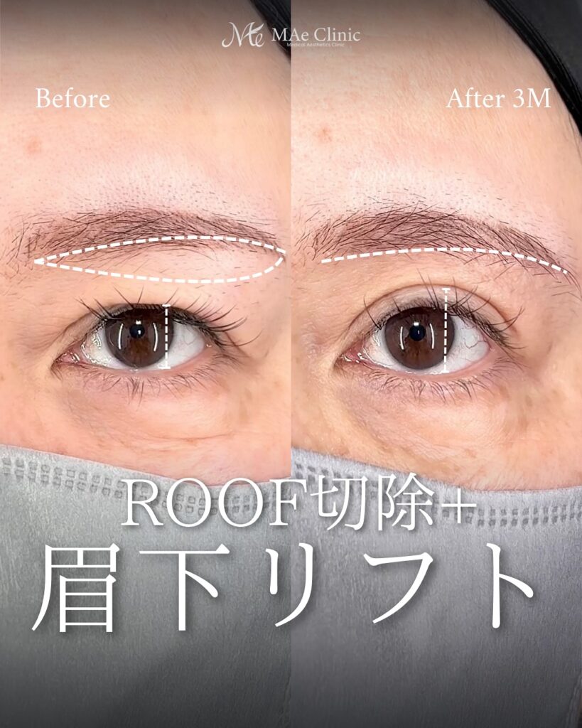 ROOF切除 眉下リフト 症例