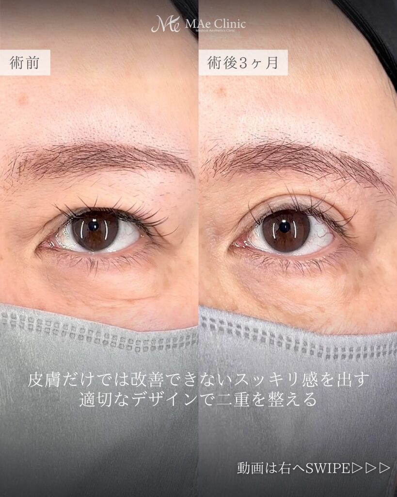 ROOF切除 眉下リフト 症例