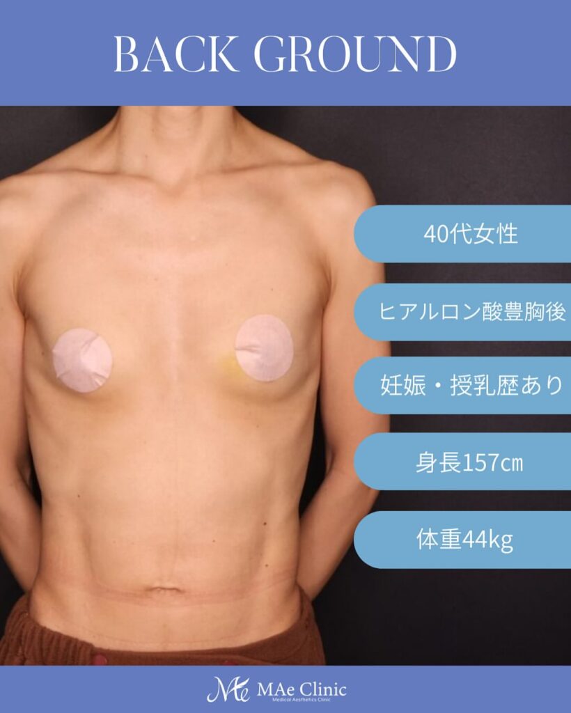 脂肪注入豊胸症例