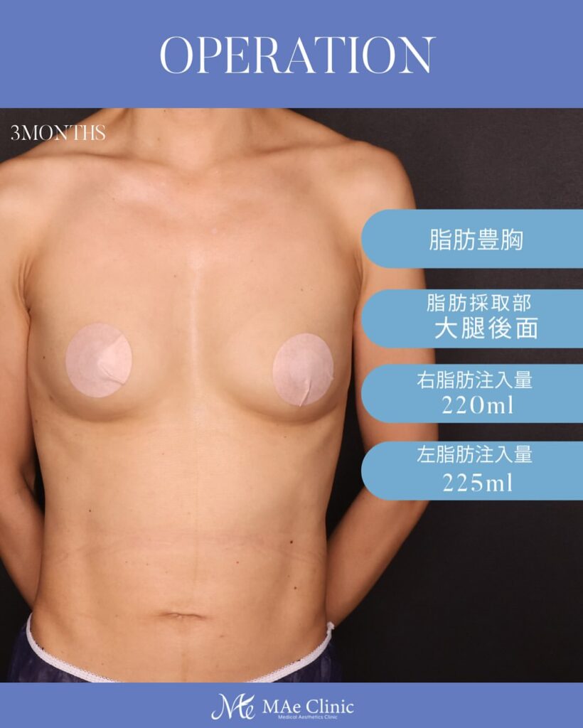 脂肪注入豊胸症例